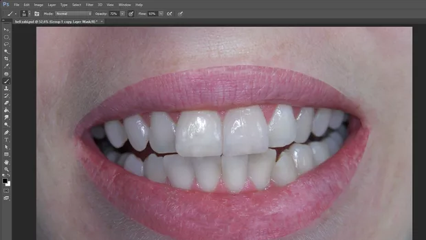 Екранна снимка към: Как да &nbsp;възвърна част от устната?